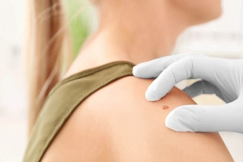 AI zmienia diagnostykę raka skóry. Czerniak pod kontrolą algorytmów