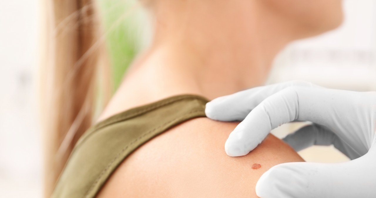 AI zmienia diagnostykę raka skóry. Czerniak pod kontrolą algorytmów