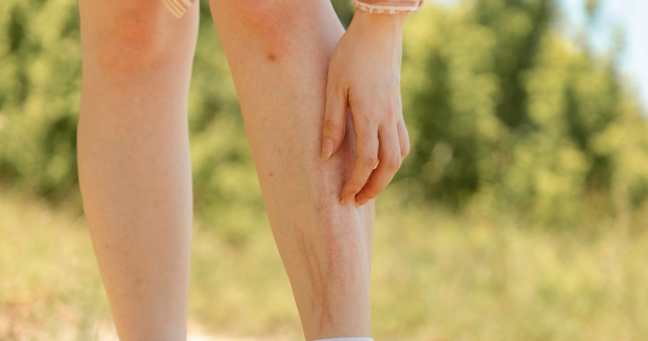 Gdzie na ciele szukać kleszcza? Te miejsca lubi najbardziej