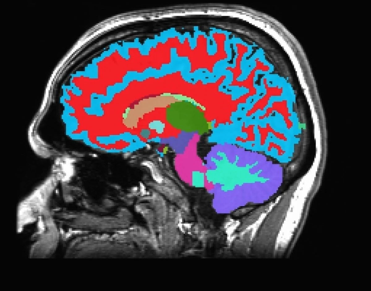 Już jeden skan mózgu może wystarczyć, by przewidzieć tempo naszego starzenia się i ryzyko demencji. Przełomowe narzędzie diagnostyczne w oparciu o technologię magnetycznego rezonansu jądrowego obiecują naukowcy z Uniwersytu Duke i Universytetu Harvarda w USA i Uniwersytetu Otago w Nowej Zelandii. Wyniki ich badań, opublikowane na łamach czasopisma "Nature Aging" pokazują, że analiza obrazu MRI mózgu pozwala przewidzieć ryzyko choroby, zanim jeszcze pojawią się pierwsze objawy. To może pomóc opóźnić jej postępy albo nawet całkowicie im zapobiec.