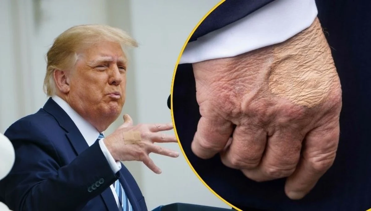 Prezydent USA Donald Trump przeszedł badania w związku z puchnącymi nogami i siniakiem na dłoni. Lekarz zdiagnozował przewlekłą niewydolność żylną, a siniak wynika z przyjmowania aspiryny i częstego ściskania dłoni - powiedziała w czwartek rzeczniczka Białego Domu Karoline Leavitt. Komunikat jest pokłosiem jednego z ostatnich zdjęć Trumpa, na którym można było zobaczyć zamaskowany siniak na dłoni polityka.