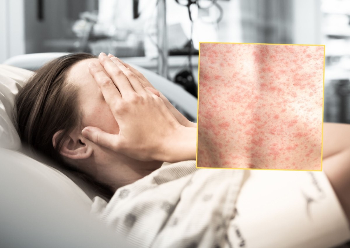 Podejrzenie odry w Olsztynie. Sanepid przekazał wyniki badań