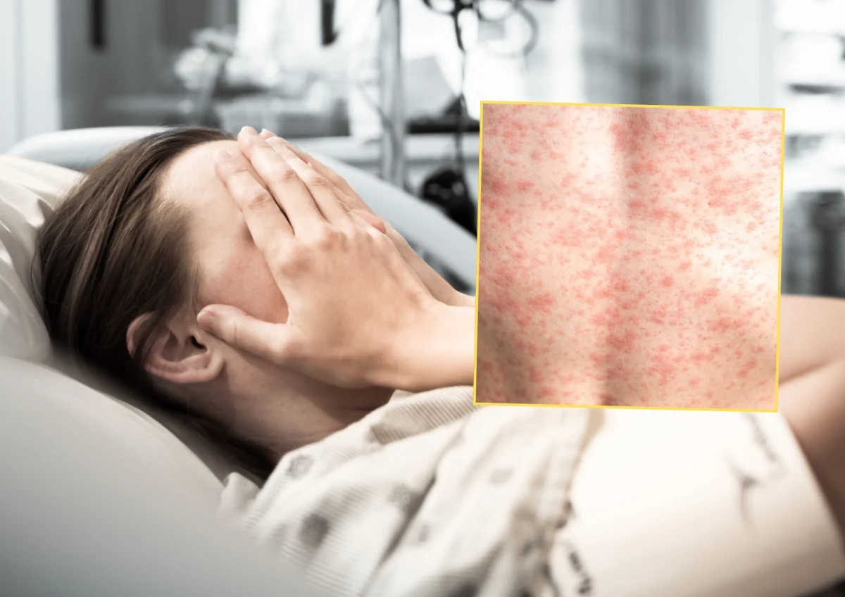 Specjalistyczne badania nie potwierdziły zakażenia odrą u dorosłej kobiety. Informację przekazały służby sanitarne, które od momentu pojawienia się pierwszych objawów prowadziły intensywne działania zapobiegawcze.