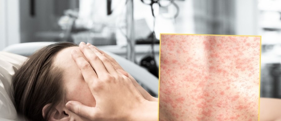 Specjalistyczne badania nie potwierdziły zakażenia odrą u dorosłej kobiety. Informację przekazały służby sanitarne, które od momentu pojawienia się pierwszych objawów prowadziły intensywne działania zapobiegawcze.