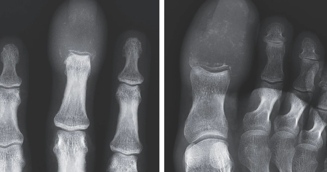 Tragiczna diagnoza. Rak płuca "zastąpił" jego palce