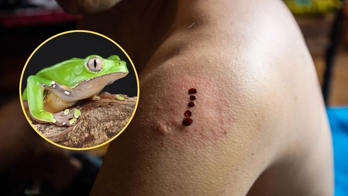 Coraz więcej osób szuka alternatywnych metod oczyszczania organizmu, jednak niektóre z nich mogą być śmiertelnie niebezpieczne. Przekonała się o tym 37-letnia kobieta, która po powrocie z Niemiec trafiła w ciężkim stanie na oddział toksykologii Szpitala Miejskiego im. F. Raszei w Poznaniu. Wszystko po udziale w tzw. rytuale kambo, podczas którego podaje się jad amazońskiej żaby.