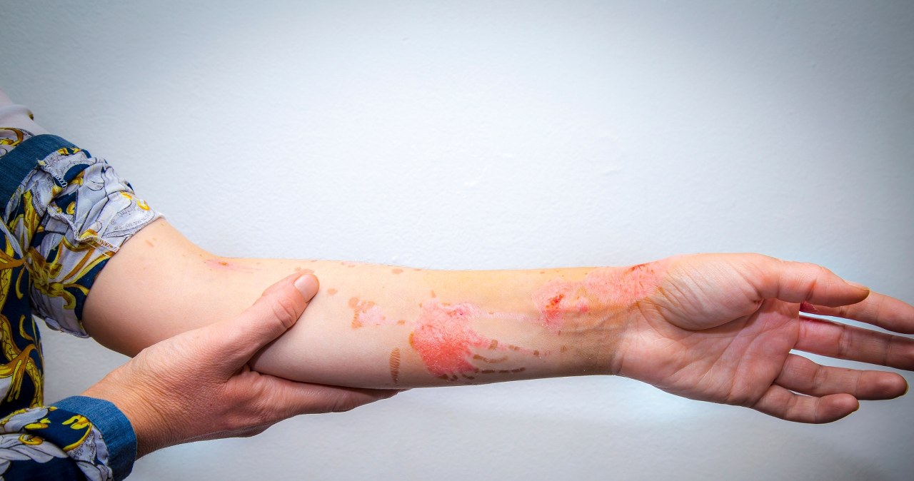 Czy ciężkie rany mogą goić się same? Szwedzi opracowali "skórę w strzykawce"