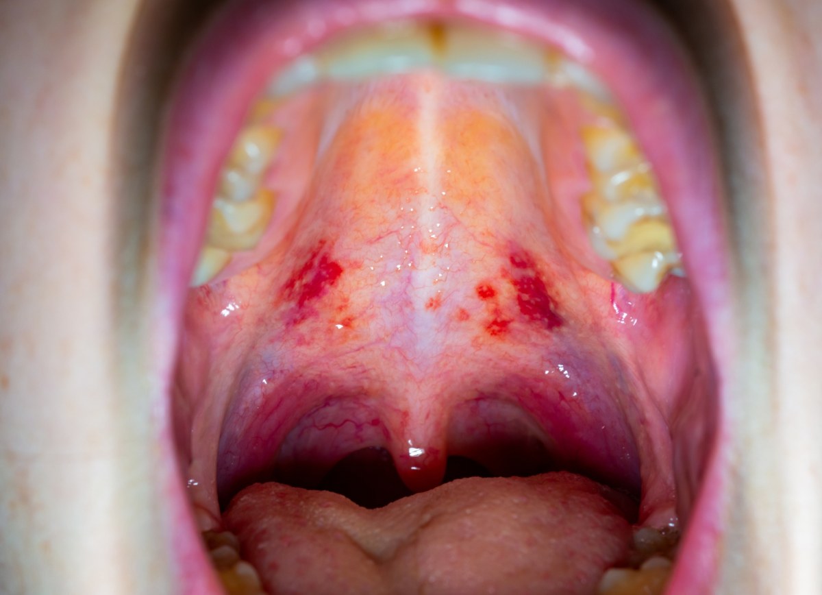 Nowe warianty COVID-19. Nietypowe objawy, "gardło jak pocięte żyletkami"