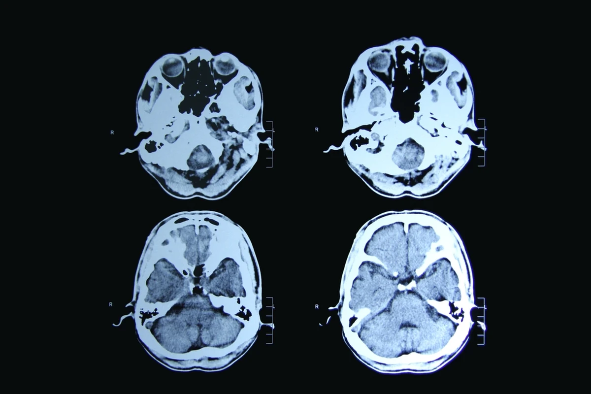 Po raz pierwszy w historii lekarzom udało się skutecznie zahamować postęp choroby Huntingtona - jednej z najcięższych i najbardziej wyniszczających chorób neurologicznych. Wyniki badań klinicznych wskazują na 75-procentowe spowolnienie rozwoju schorzenia u pacjentów poddanych nowatorskiej terapii genowej.