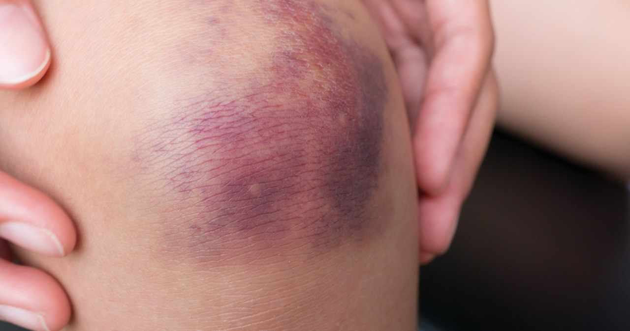 Nie znikały jej siniaki, trafiła do szpitala. Diagnoza była szokiem