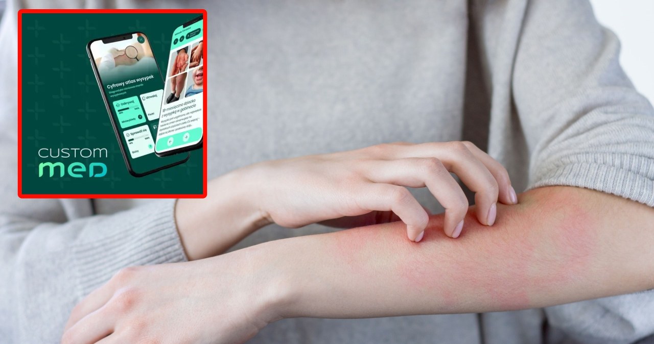 Co to za wysypka? Polscy naukowcy stworzyli wyjątkową aplikację