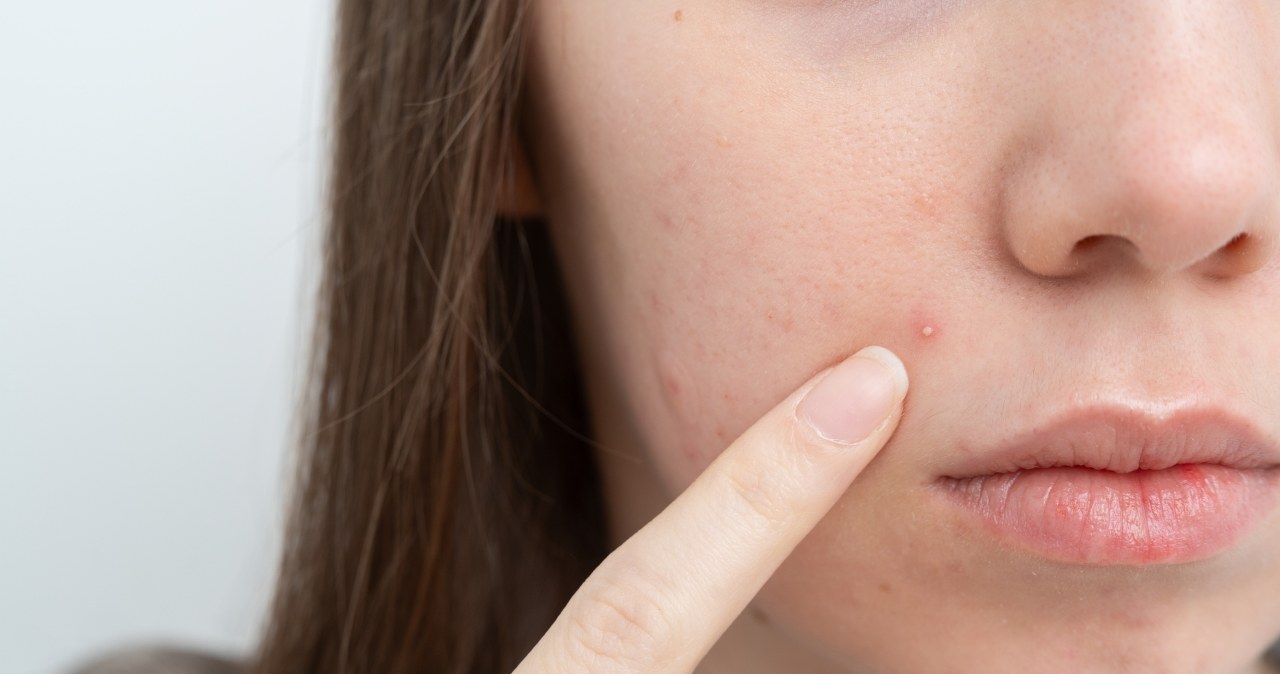 Domowa mikstura na pryszcze i zaskórniki. Wystarczy wymieszać składniki z kuchni