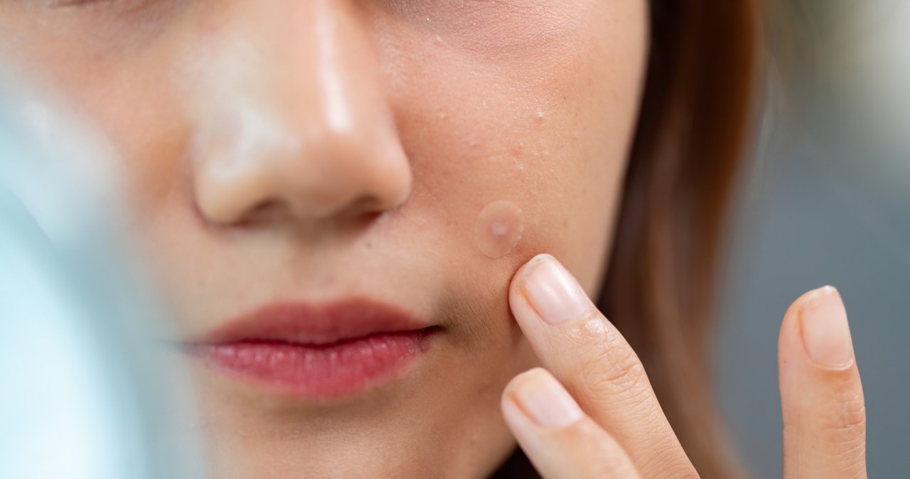 Zanim nakleisz na pryszcza, sprawdź. Nie wszystkie zadziałają idealnie