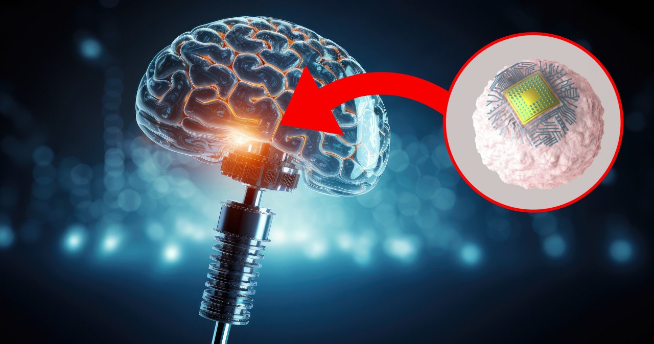 Mikroimplant zamiast operacji mózgu. Podają go dożylnie