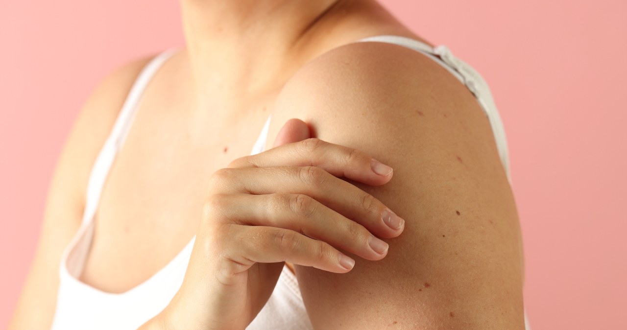 Czerwone kropki na ciele to nie pieprzyki. Co oznaczają rubinki?