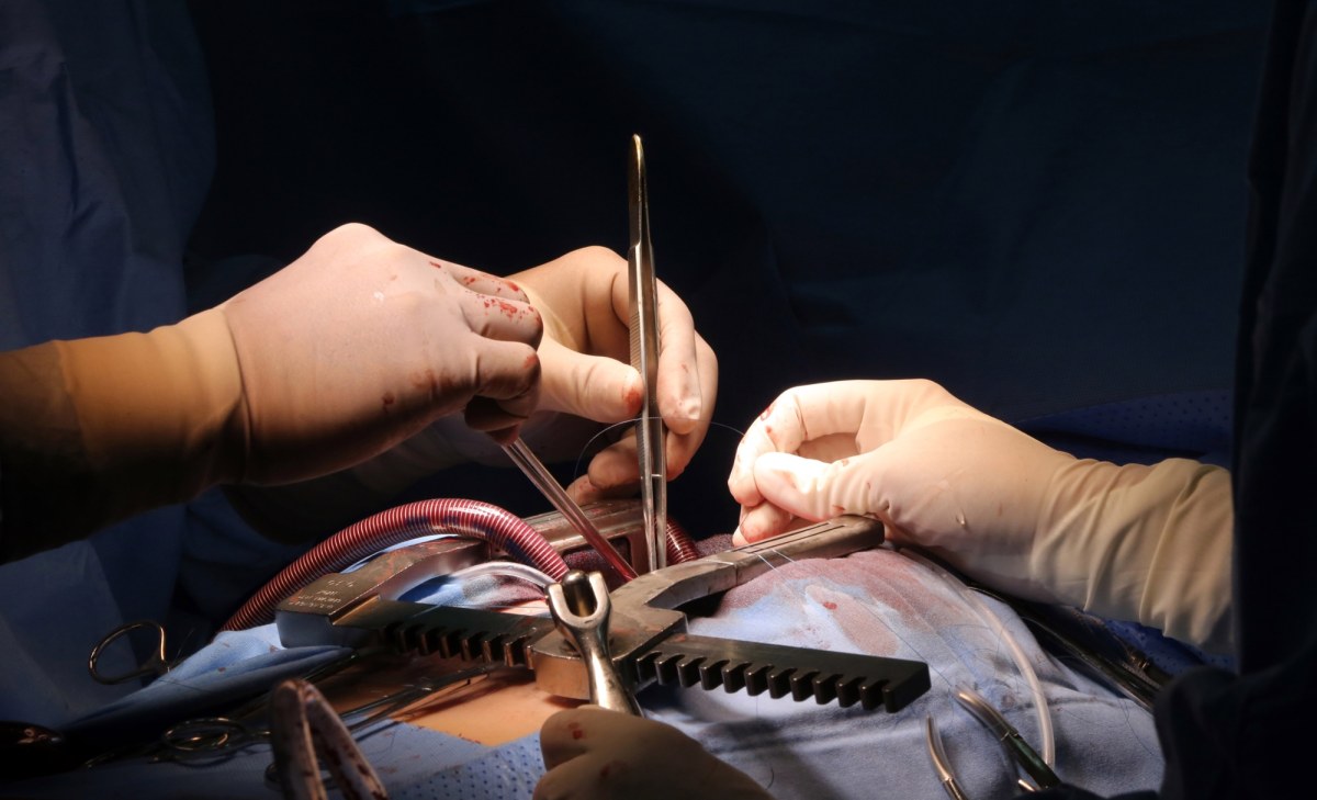 Dwa zabiegi naraz, by uniknąć nowego udaru. Śląski szpital z wyjątkową procedurą