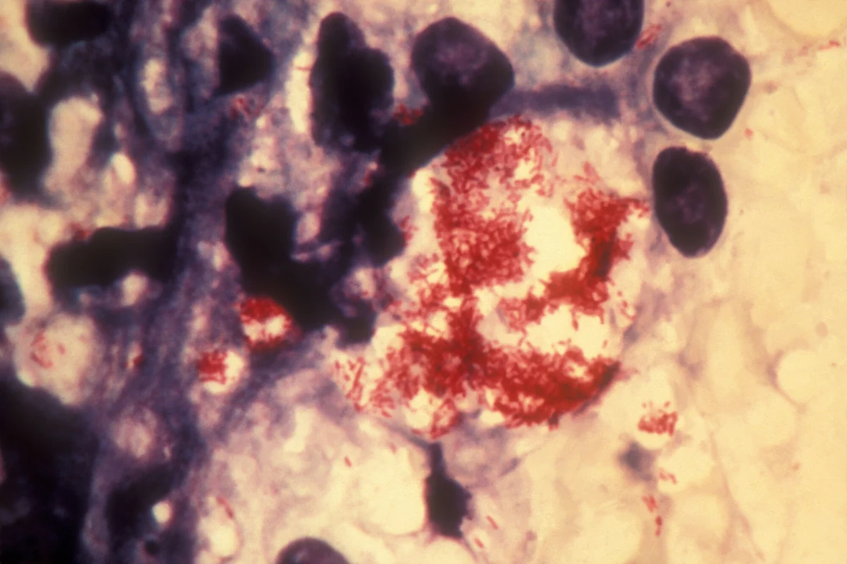 Przypadki trądu wykryto w Rumunii i Chorwacji. Obecność choroby potwierdziły władze. Zarażeni zostali poddani leczeniu. Opiekę medyczną otrzymały również osoby, które miały z nimi kontakt.