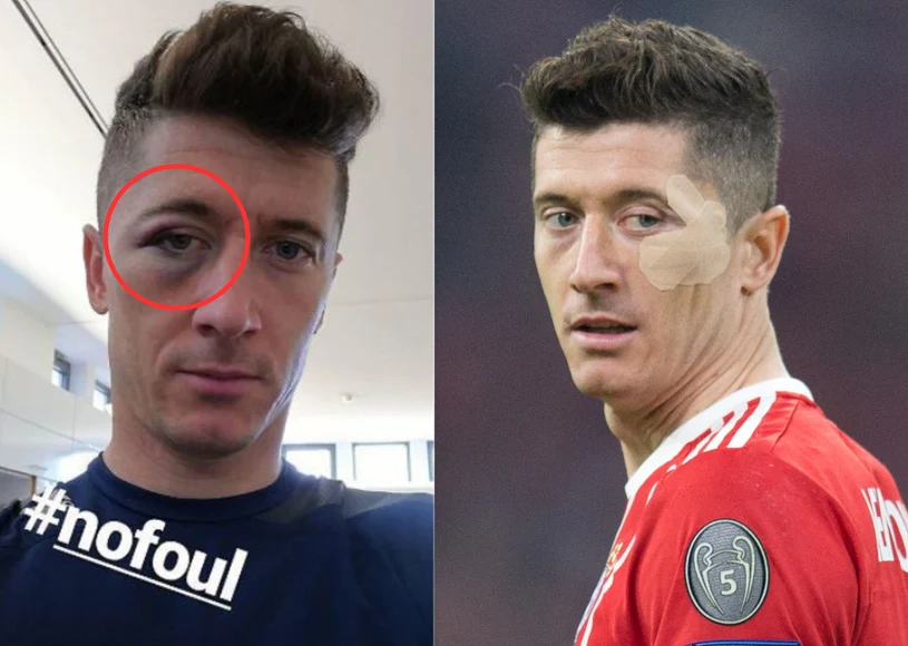 Tak wyglądało oko Lewandowskiego. O tym huczał cały świat. Zdjęcie dowodem