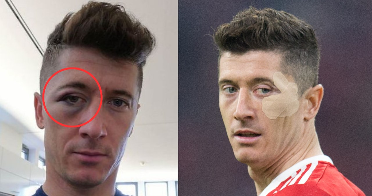 Tak wyglądało oko Lewandowskiego. O tym huczał cały świat. Zdjęcie dowodem