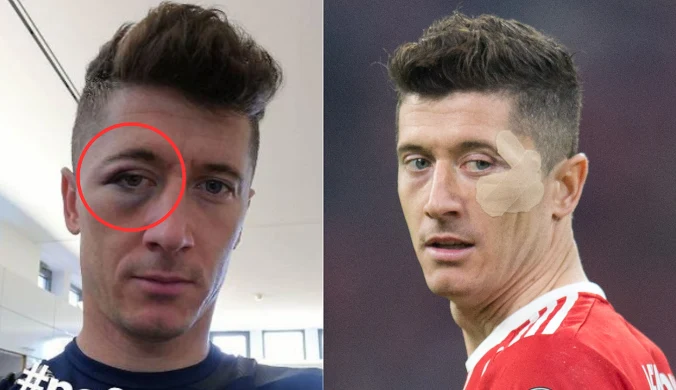 Tak wyglądało oko Lewandowskiego. O tym huczał cały świat. Zdjęcie dowodem