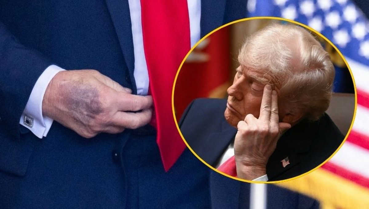 Od siniaków po problemy ze snem. Trump o tym, dlaczego ignoruje zalecenia lekarzy