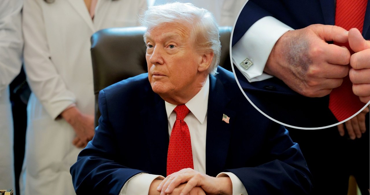 Aspiryna, żylaki i bezsenność. Trump tłumaczy, dlaczego nie słucha lekarzy