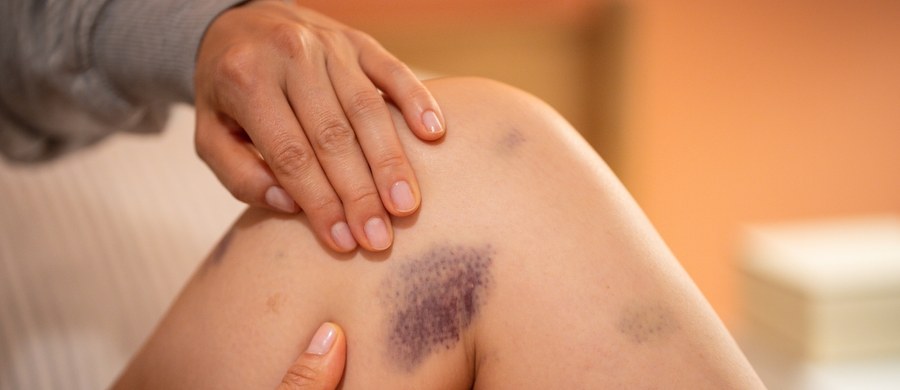 Upadek, uderzenie, mocny uścisk – wydaje się że doskonale wiemy, skąd biorą się siniaki. Przyczyn ich powstawania najczęściej szukamy na zewnątrz, a ból – który zwykle poprzedza ich powstawanie – powoduje, że pamiętamy co i kiedy się stało. Zdarza się jednak, że nie potrafimy sobie przypomnieć, dlaczego mamy ten zmieniający kolor ślad na skórze. A jeżeli brak czynników zewnętrznych – to trzeba ich poszukać wewnątrz, w organizmie.