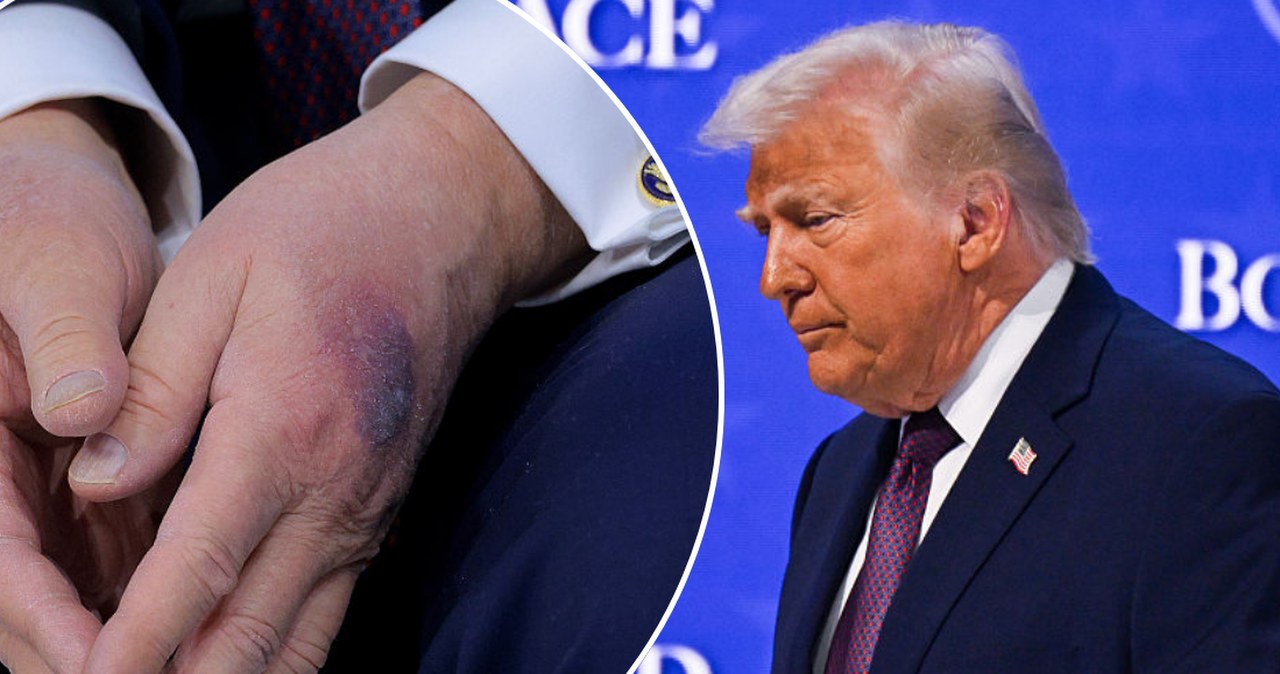 Niepokojący wygląd dłoni Trumpa. Biały Dom reaguje, jest oświadczenie