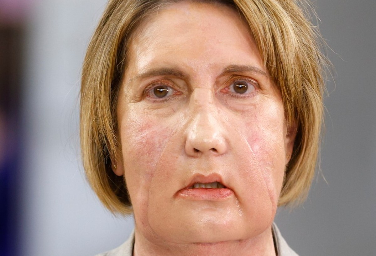 Infekcja "wyżarła" tej kobiecie twarz. Dostała nową dzięki eutanazji