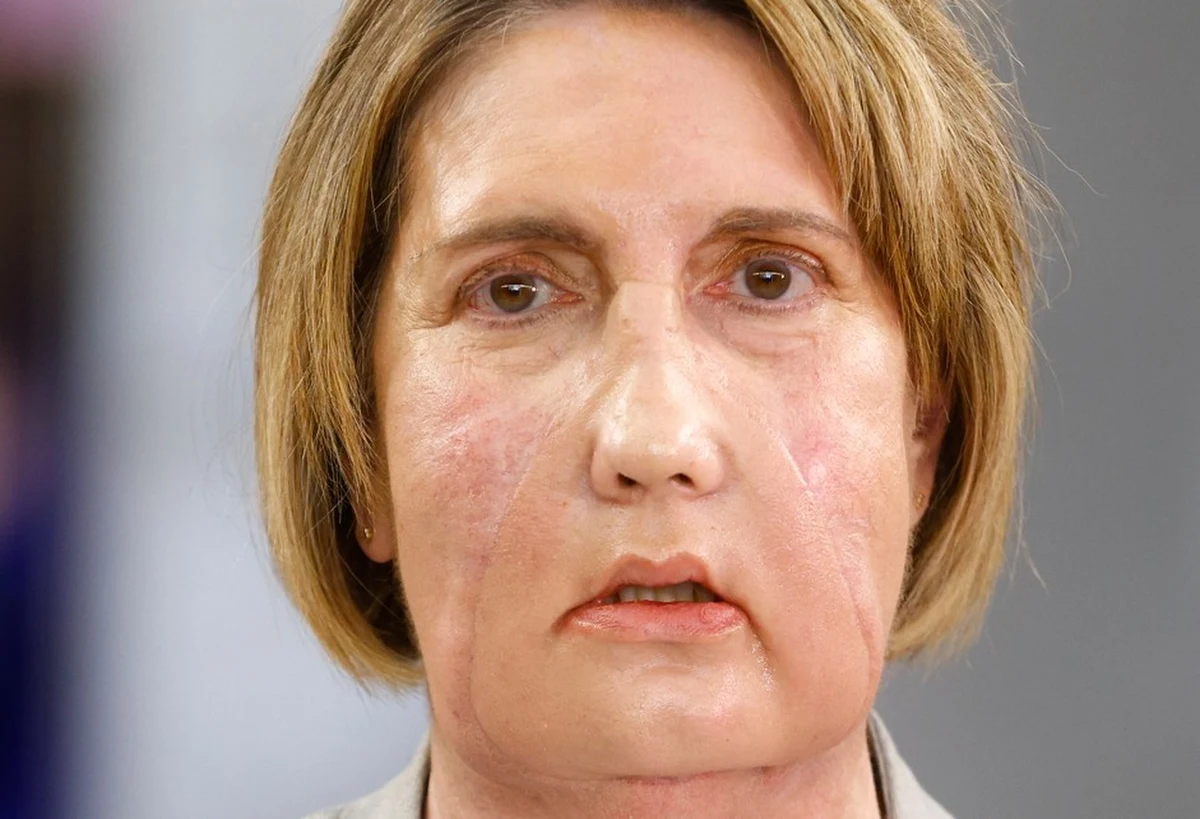 W Barcelonie dokonano pierwszego na świecie przeszczepu twarzy od dawczyni, która przed śmiercią zdecydowała się na eutanazję i świadomie przekazała swoją twarz do transplantacji. Operacja została przeprowadzona u pacjentki, która doznała poważnych uszkodzeń tkanek na skutek infekcji po ukąszeniu przez owada. Choroba upośledziła podstawowe funkcje, w tym oddychanie, jedzenie i mówienie.  