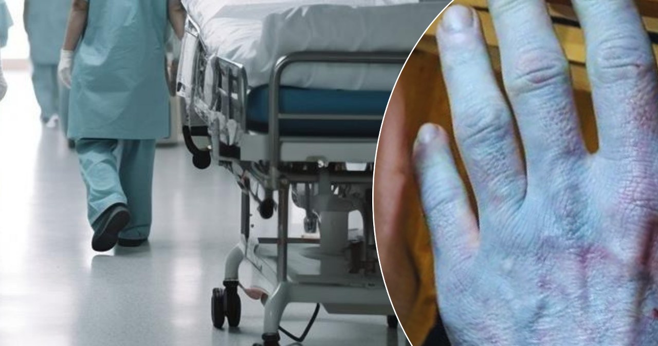 Obudził się niebieski, zszokował lekarzy. To nie problemy z krążeniem