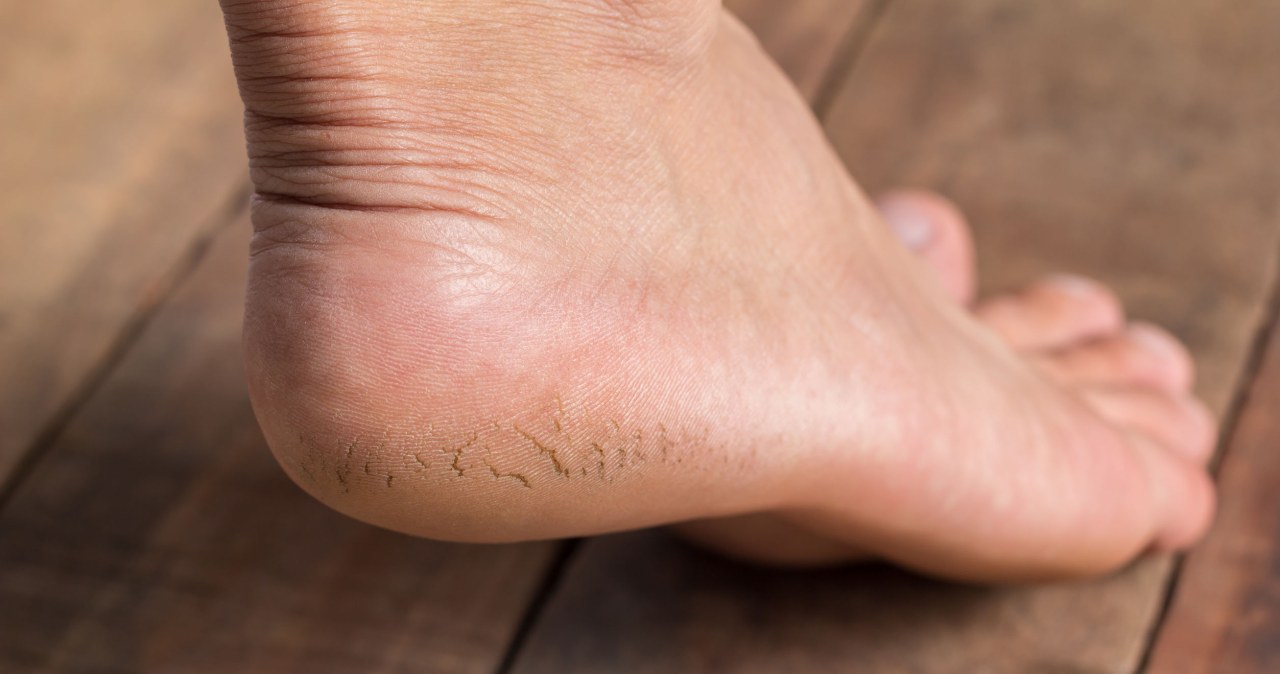 Kup w aptece i nałóż na pięty. Będą gładkie całą wiosnę