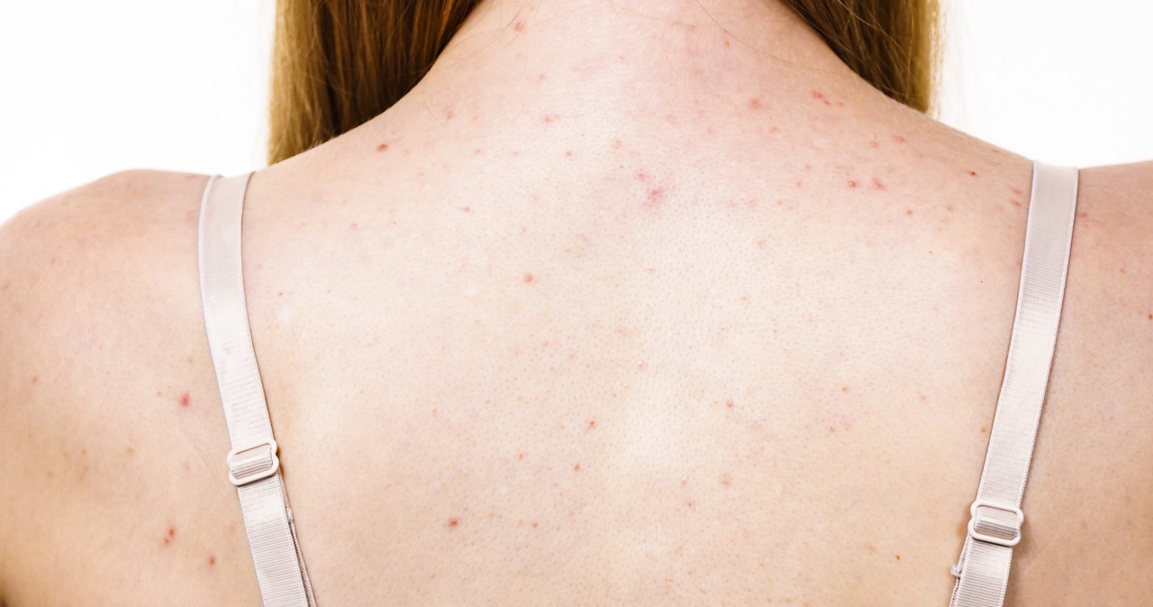 Dlaczego krosty na plecach nie znikają? Oto 6 najczęstszych błędów