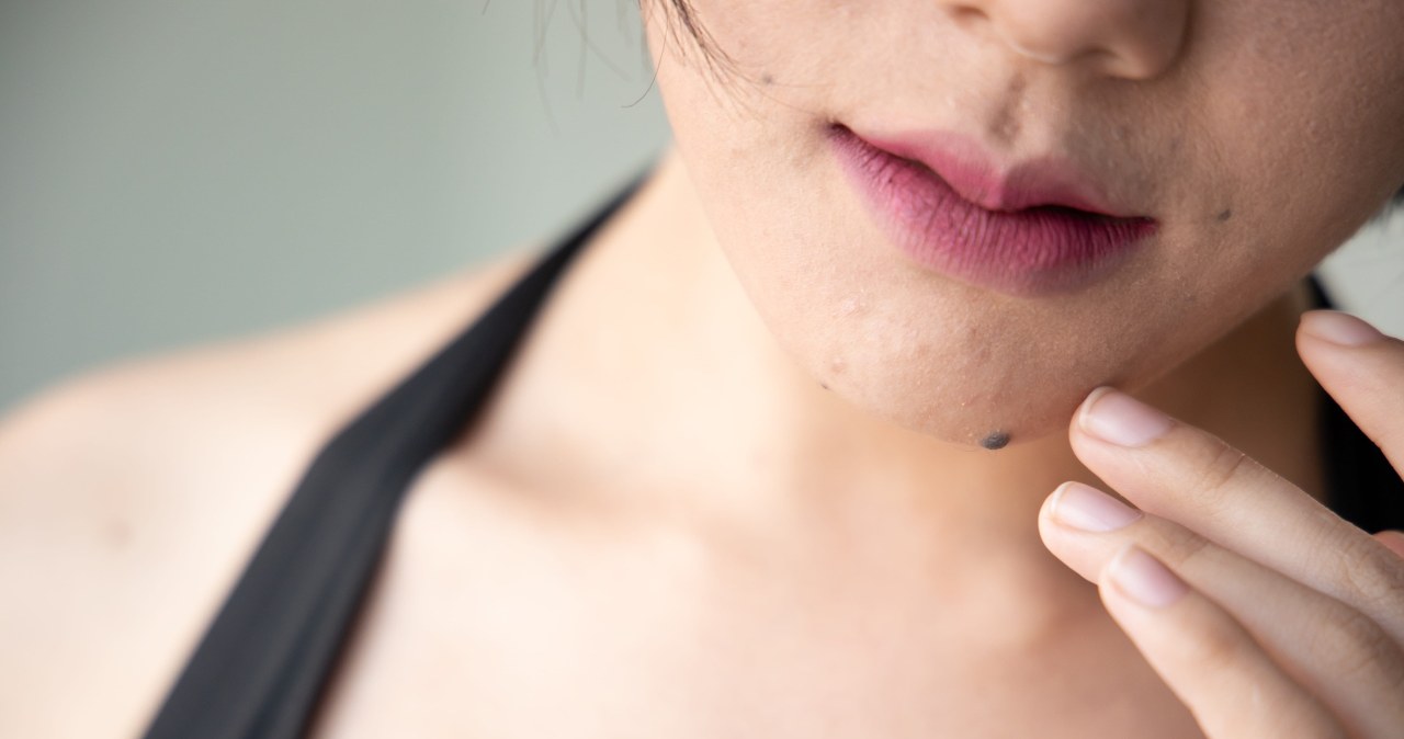 Pojawia się nagle i trudno go przeoczyć. "Włos czarownicy" ma konkretne przyczyny