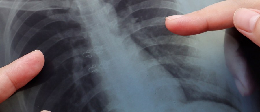 Około 21 tys. przypadków rocznie - rak płuca jest jednym z najczęściej występujących nowotworów złośliwych w Polsce, zarówno pod względem liczby zachorowań, jak i zgonów. Podstawą są: wczesna diagnostyka i regularne badania profilaktyczne, które znacząco zwiększają szanse na skuteczne leczenie i poprawę jakości życia pacjentów. Jedną z takich najbliższych okazji może być „Biała Sobota” w Szczucinie, która odbędzie się już 11 kwietnia.