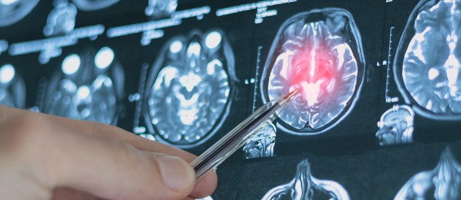 Jeżeli w pewnym miejscu ściana tętnicy jest słabsza i powstaje tam zgrubienie ponad 50 proc. szersze niż na całej długości naczynia – to mamy do czynienia z tętniakiem. Ten proces zwykle przebiega bezobjawowo – dlatego nie zdajemy sobie sprawy z jego obecności i zagrożenia, bo taki pęcherzyk w każdej chwili może pęknąć. Choć mogą tworzyć się w każdej części ciała – to najgroźniejsze są te zlokalizowane: w głowie, brzuchu i klatce piersiowej. Wybuch takiej tykającej bomby jest śmiertelnie groźny i tym tematem zajmujemy się w cyklu "Twoje Zdrowie w Faktach RMF FM".