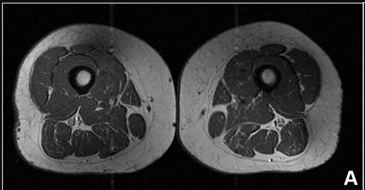 Dieta bogata w wysokoprzetworzone produkty powoduje odkładanie się w mięśniach tłuszczu do tego stopnia, że ludzkie uda zaczynają wyglądać jak marmurkowe steki. Tłuszcz odkłada się niezależnie od ilości spożywanych kalorii.