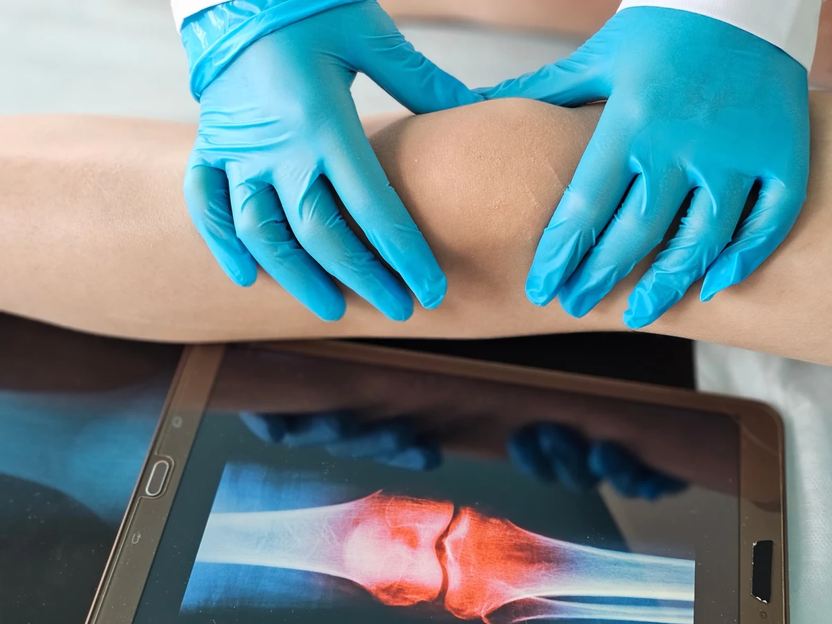 Wyniki przełomowego, dziesięcioletniego badania klinicznego podważają skuteczność jednej z najczęściej wykonywanych operacji ortopedycznych na świecie - częściowej meniscektomii. Naukowcy wykazali, że zabieg ten nie tylko nie przynosi oczekiwanej ulgi w bólu kolana, ale może wręcz pogarszać stan pacjentów w dłuższej perspektywie.