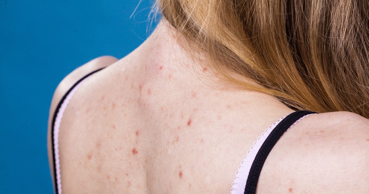 Wypryski na plecach latem do zmora. Dermatolog radzi, jak się ich pozbyć
