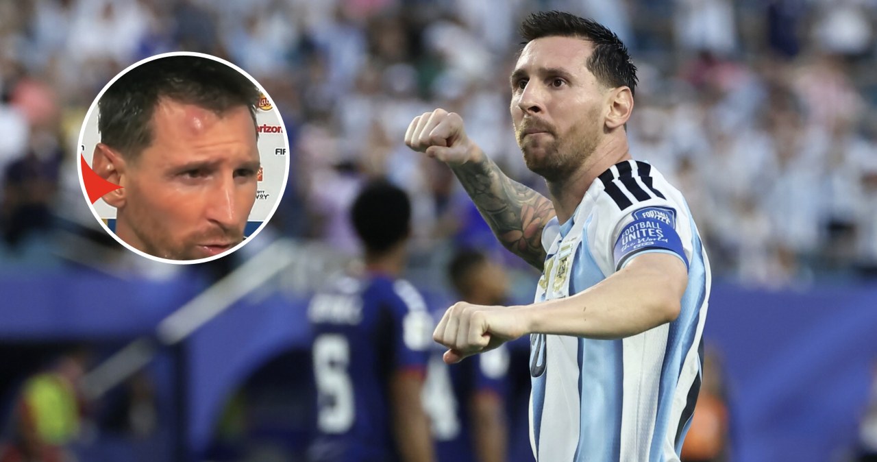 Messi nieźle oberwał. Po meczu pokazał swoją twarz. Musiało boleć