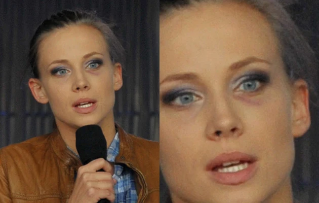 Ola Rosiak i jej podbite oko, fot.Maciej Gostyński