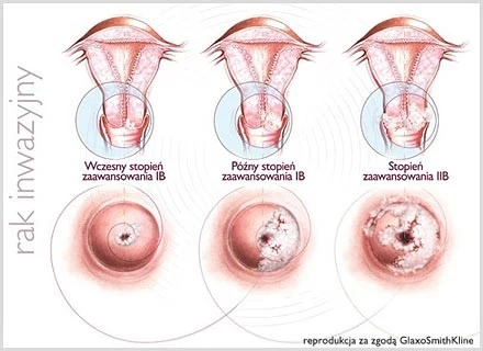 Co roku u około 500 000 kobiet na świecie stwierdza się raka szyjki macicy.