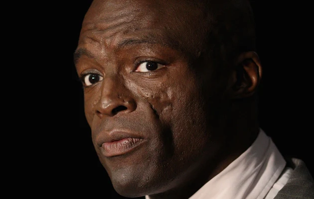 Blizny na twarzy to pozostałość po chorobie, na którą Seal cierpiał w młodości - toczniu rumieniowatym układowym