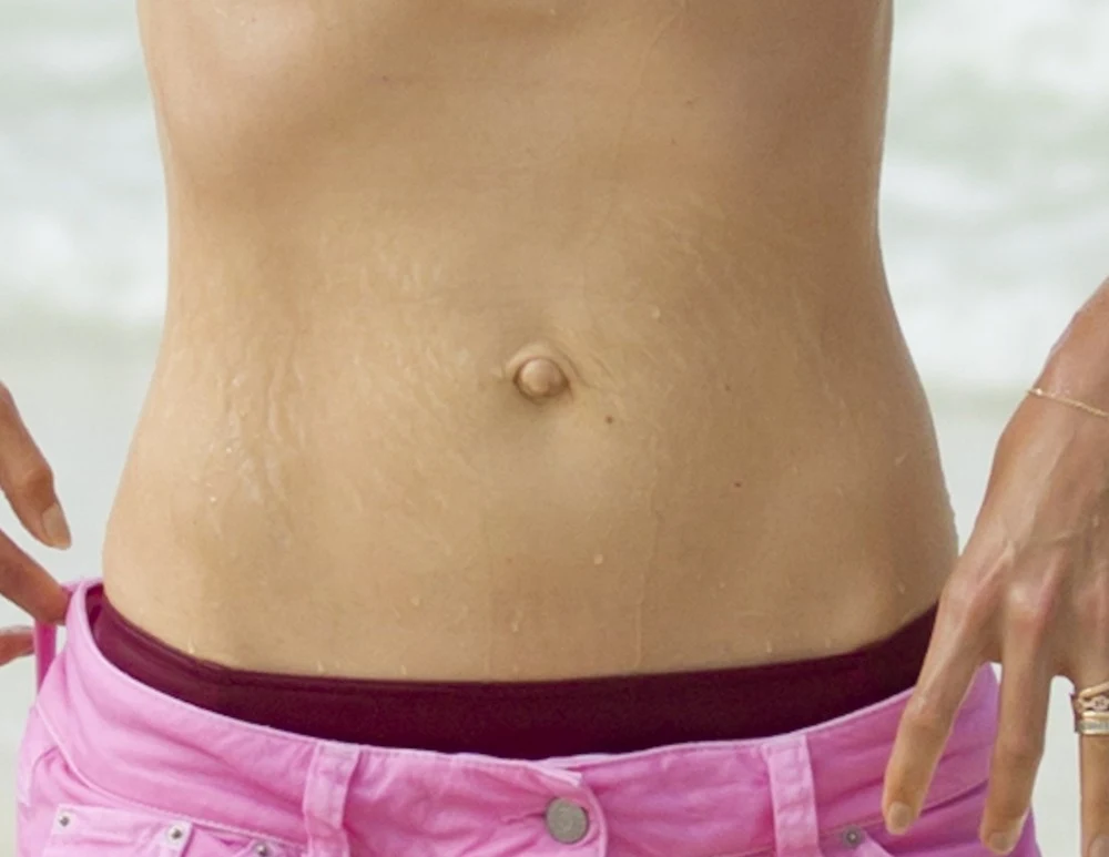 Rozstępy Katie Holmes