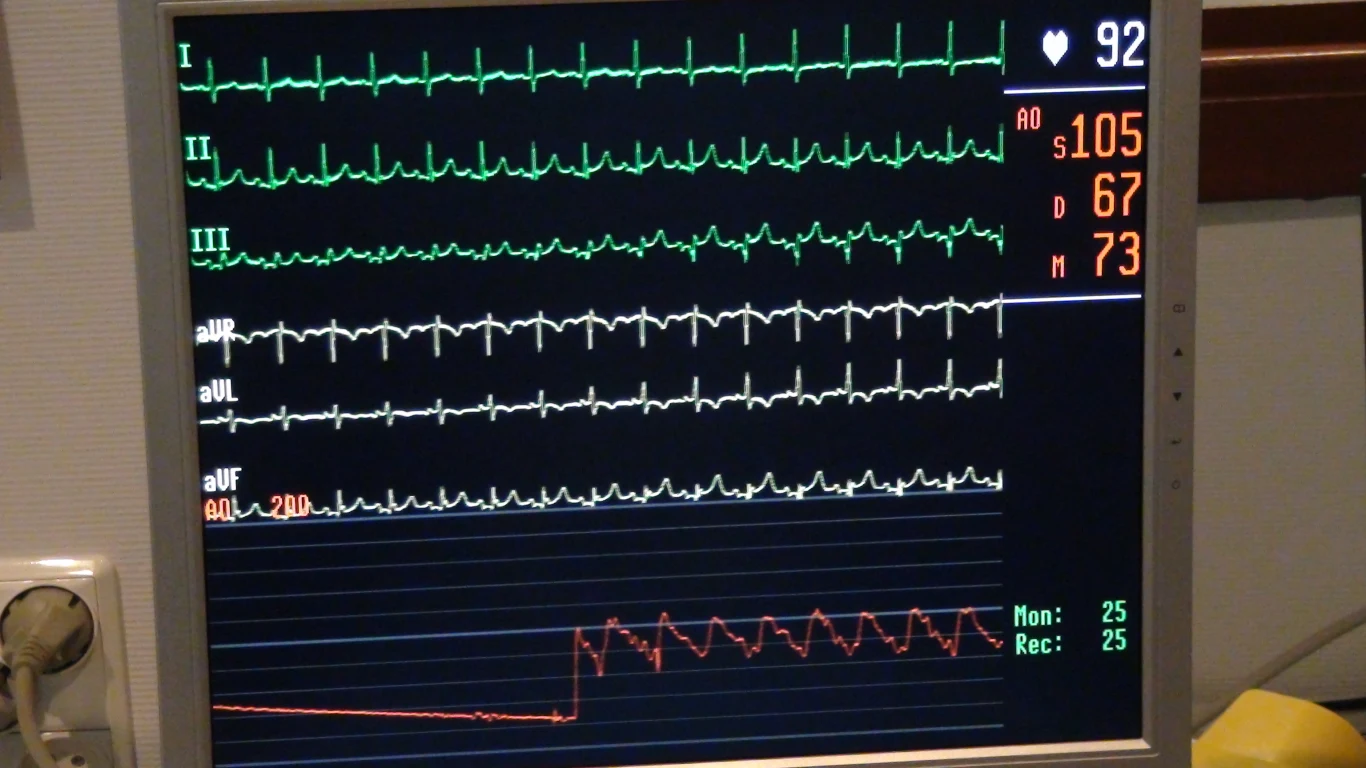 Zabieg przeprowadził zespół kardiologów pod przewodnictwem Profesora Dariusza Dudka z Pracowni Hemodynamiki i Angiografii Szpitala Uniwersyteckiego w Krakowie 