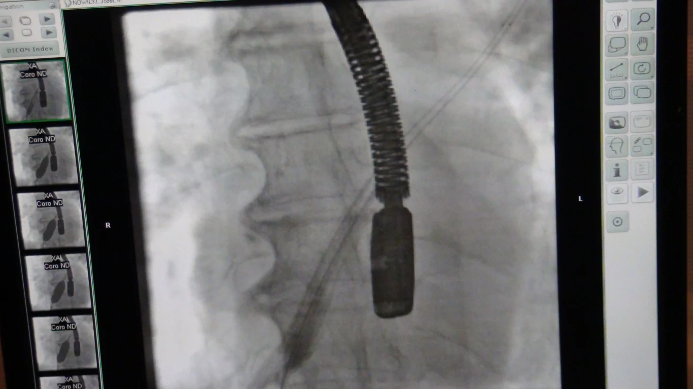 Zabieg przeprowadził zespół kardiologów pod przewodnictwem Profesora Dariusza Dudka z Pracowni Hemodynamiki i Angiografii Szpitala Uniwersyteckiego w Krakowie 