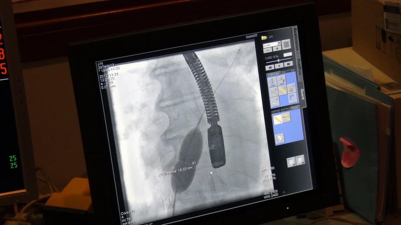 Zabieg przeprowadził zespół kardiologów pod przewodnictwem Profesora Dariusza Dudka z Pracowni Hemodynamiki i Angiografii Szpitala Uniwersyteckiego w Krakowie 