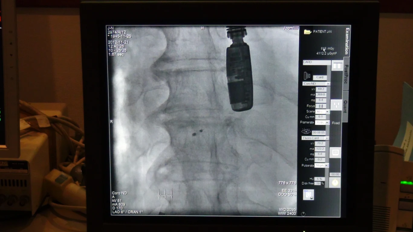 Zabieg przeprowadził zespół kardiologów pod przewodnictwem Profesora Dariusza Dudka z Pracowni Hemodynamiki i Angiografii Szpitala Uniwersyteckiego w Krakowie 