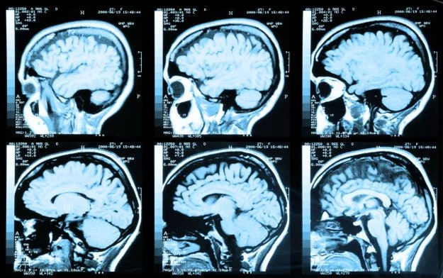 Operacje neurochirurgiczne są w stanie zmienić naszą osobowość