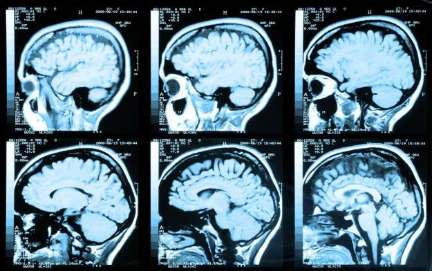 Operacje neurochirurgiczne są w stanie zmienić naszą osobowość Operacje neurochirurgiczne są w stanie zmienić naszą osobowość